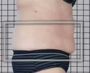 nach einer Icoone-Laser-Behandlung (Bauchumfang kleiner)