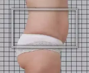 nach einer Icoone-Laser-Behandlung (Bauchumfang kleiner)