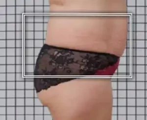 vor einer Icoone-Laser-Behandlung (Bauchumfang größer)