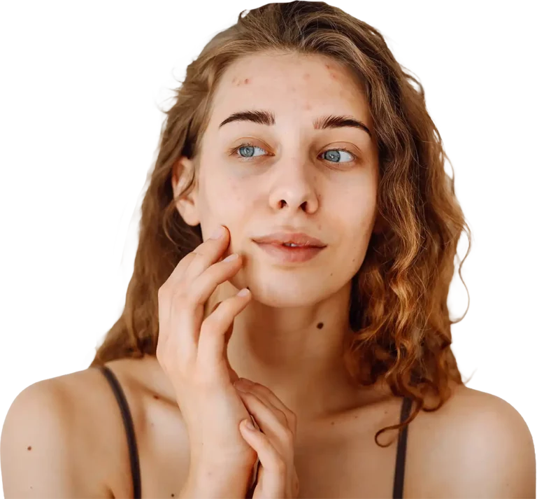 Junge Frau mit Akne Narben im Gesicht