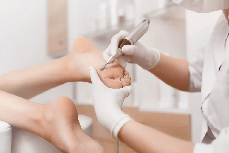 Füße erhalten eine professionelle Behandlung gegen Hühneraugen