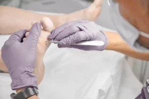 Füße erhalten eine professionelle Behandlung gegen Hühneraugen