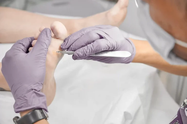 Füße erhalten eine professionelle Behandlung gegen Hühneraugen