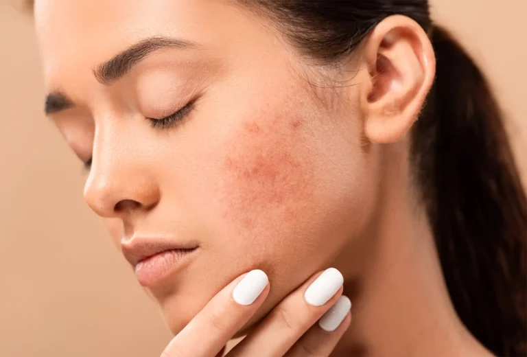 Junge Frau mit Akne Narben an der Wange