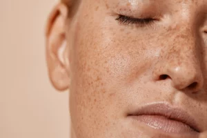 Nahaufnahme des Gesichtes einer jungen Frau mit gepflegter Haut und vielen Sommersprossen